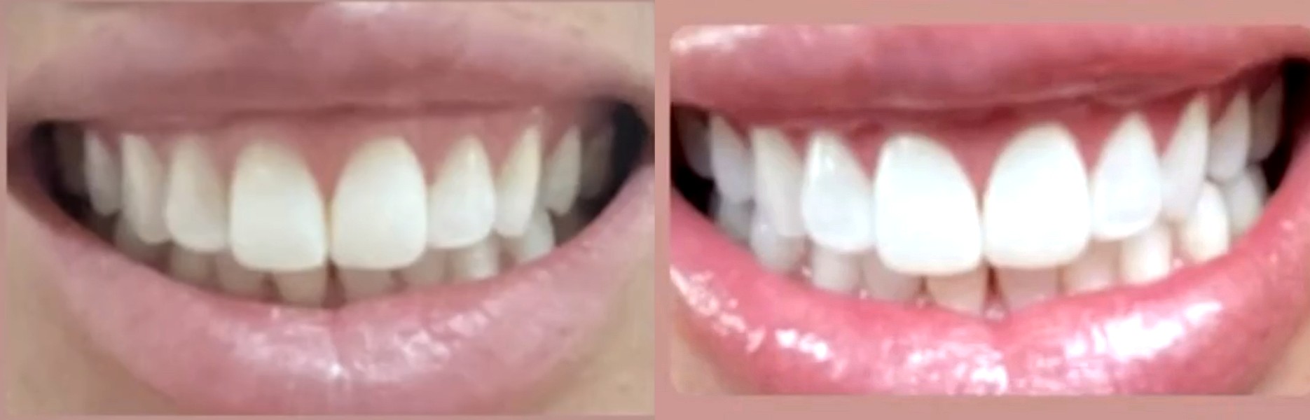 Real before and after laser teeth whitening results at Desert Rose Retreat, Prescott AZ — dramatic whitening in one session