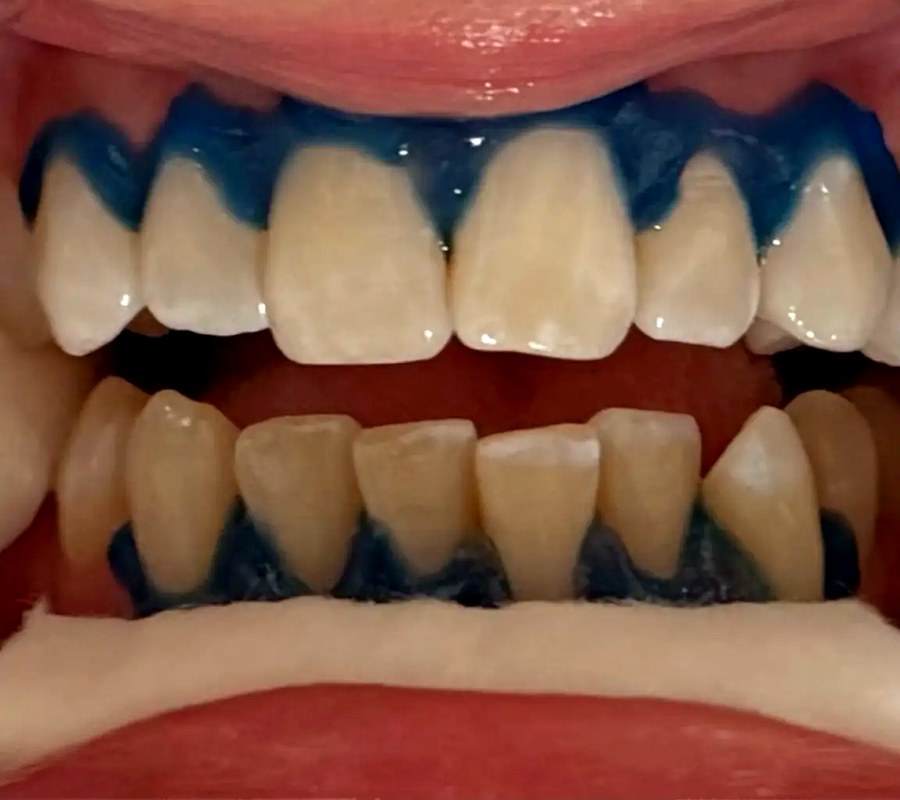 Protective gum barrier applied before laser teeth whitening at Desert Rose Retreat Prescott AZ